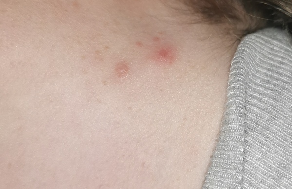 Hormonal neck/jawline spots?