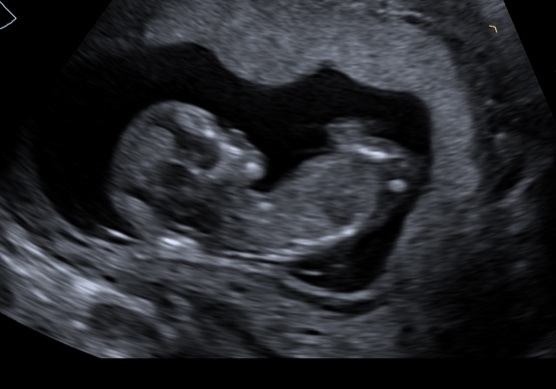 To think I’m losing this pregnancy :-(