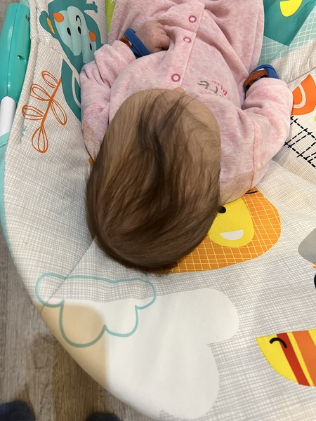 Anyone have experience with Sagittal craniosynostosis?