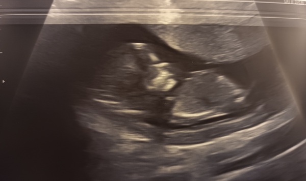 Gender Guess - Any Nub Theory Experts?