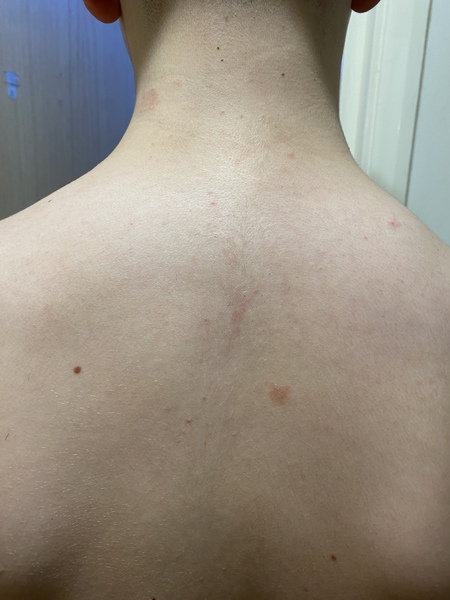 What is this rash?