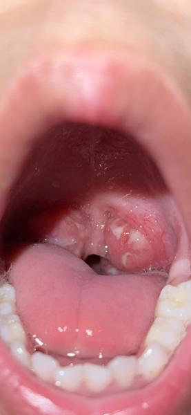 Tonsillitis pic