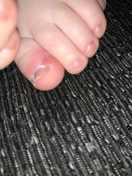 TOE !! And picture