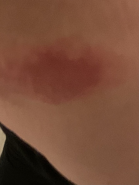 Is this shingles?