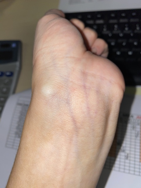 Ganglion cyst on inside of my left wrist