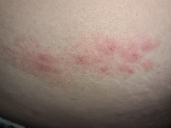 Anyone hazard a guess at this rash?