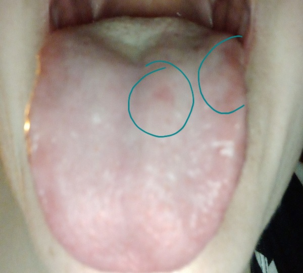 Sertraline, side effects- tummy pain, bloat, anxiety