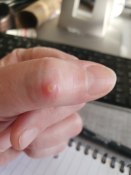 What is this on my thumb? A warr?