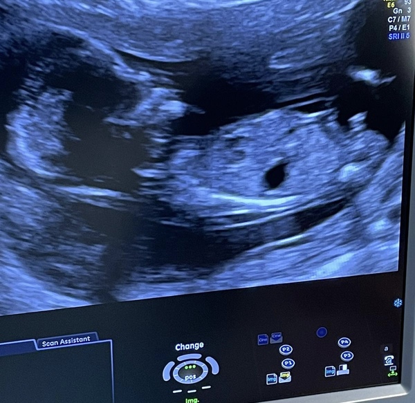 Am i having a girl or boy?