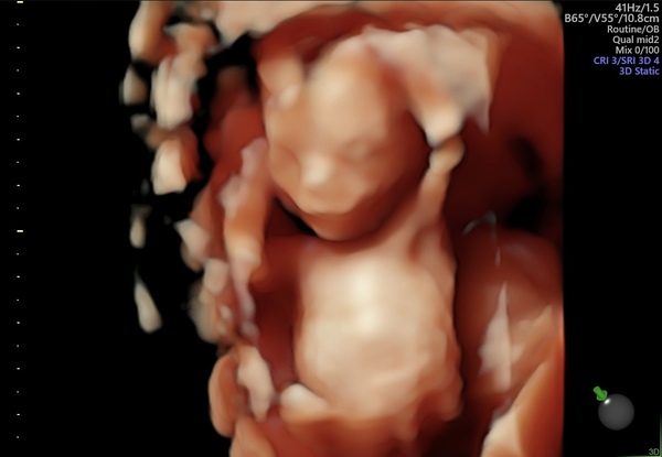 Pregnancy after 3 recurrent miscarriages