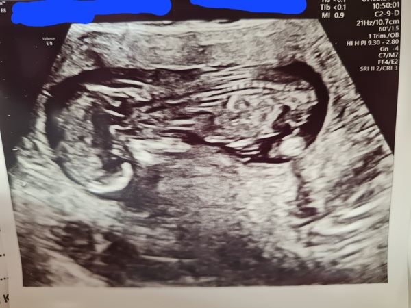 IVF Pregnancies (thread 2)