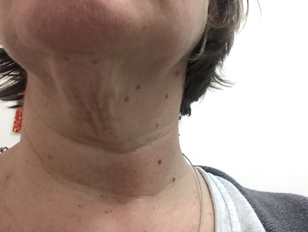 Saggy neck - help!