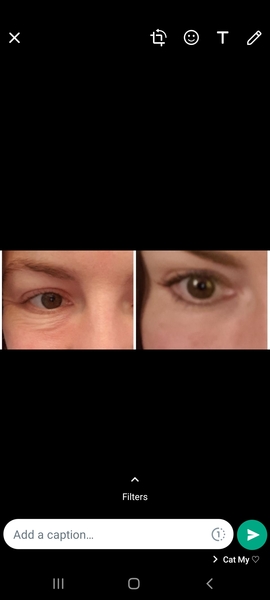 Bags under eyes - not dark circles