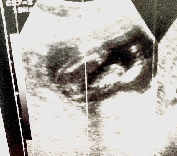 Boy Or Girl????