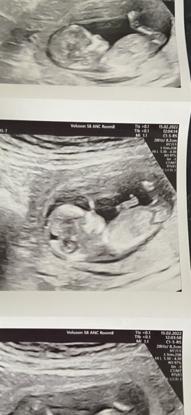 Boy or girl? 13 weeks