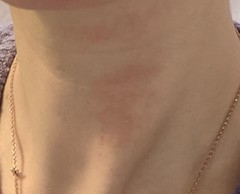 Red patches on neck