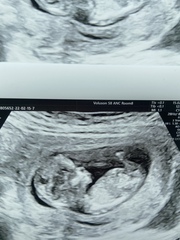 Boy or girl? 13 weeks