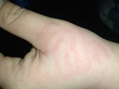 Treatment for burn