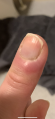 Infected finger?