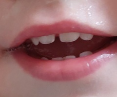 Tooth decay or something else?