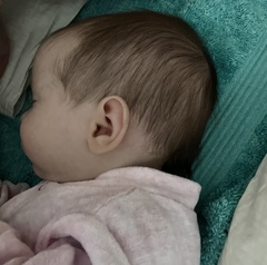 Anyone have experience with Sagittal craniosynostosis?