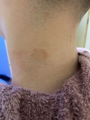 What is this rash?