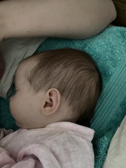Anyone have experience with Sagittal craniosynostosis?