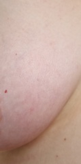 Persistently itchy nipple, now change in breast texture - worried