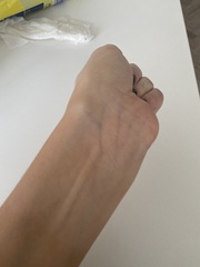 Ganglion cyst on inside of my left wrist