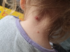 Skin tag?