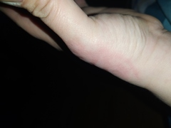 Treatment for burn