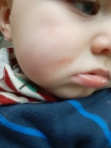 What is this rash?