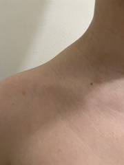 What is this rash?