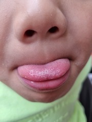 Painful tongue DS