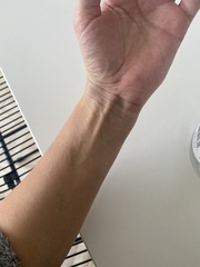 Ganglion cyst on inside of my left wrist