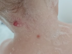 Skin tag?