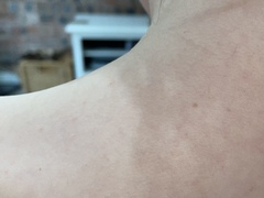 Daughters rash