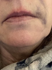 Has anyone had fillers for jowls and marionettes?