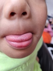 Painful tongue DS