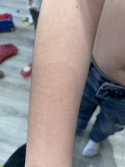 Daughters rash