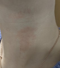 Red patches on neck