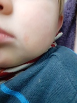 What is this rash?