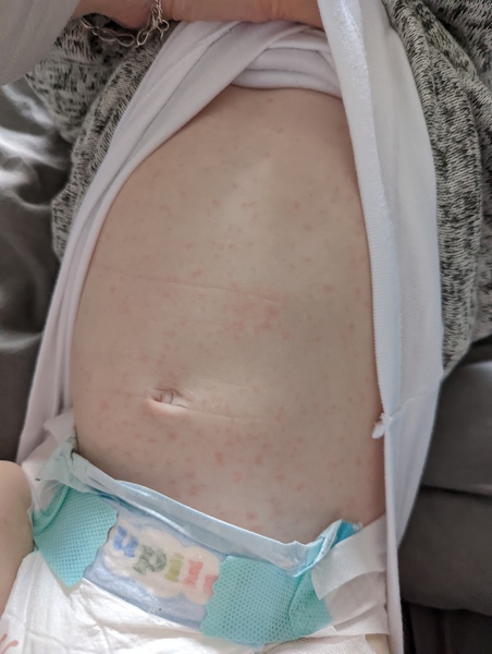 Normal for MMR vaccine?? Worrying.