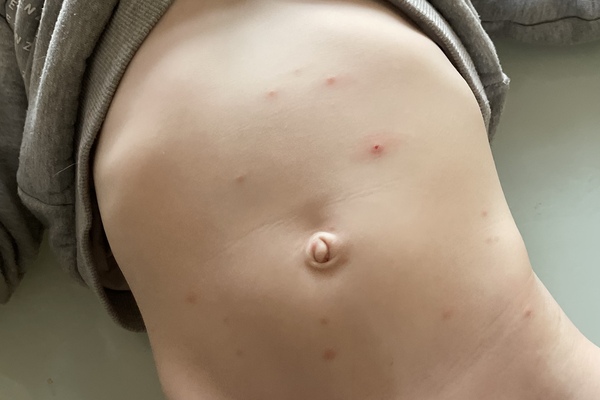 Could it be chicken pox? Only been back at school 5 days