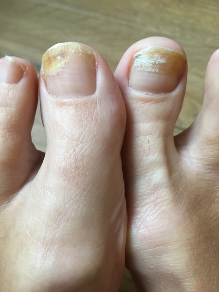 Toe Nail Fungus; Do OTC remedies work?
