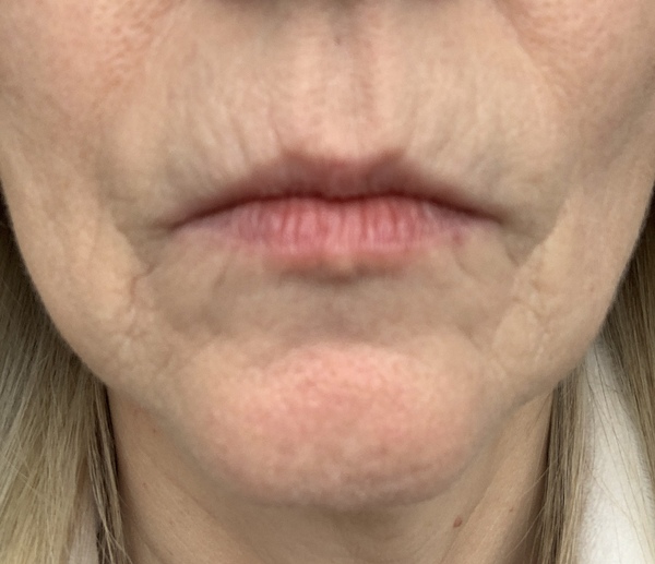 Help with facial lines!