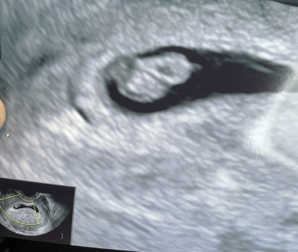 👶 Due November 2022 - part II 🎆