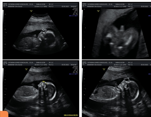 20week scan 😍