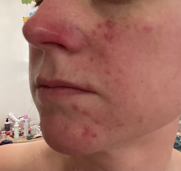 Does this look like rosacea?