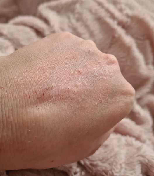 What the bloody hell is biting me?! Pic included